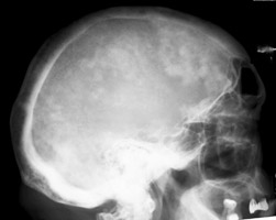 Lateral skull - Click on the image for a larger version