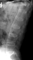 Lateral L-spine - Click on the image for a larger version