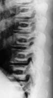 Lateral thoracic spine - Click on the image for a larger version