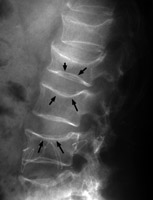 Lateral L-spine - Click on the image for a larger version