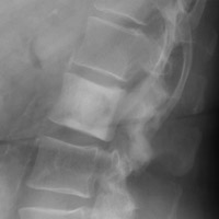 Lateral lumbar spine - Click on the image for a larger version