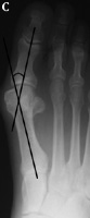 Moderate Hallux Valgus