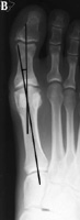 Normal Hallux Valgus Angle