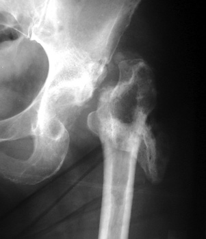 How are hip replacement infections treated?